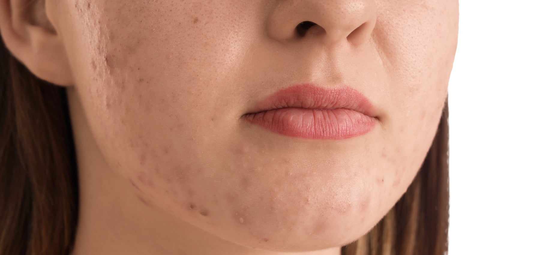 Cystic Acne: Causes & How to Ease It