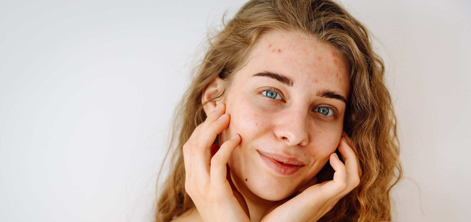 Bacterial Acne Skincare Routine: Best Skincare Regimen To Help With Bacterial Acne