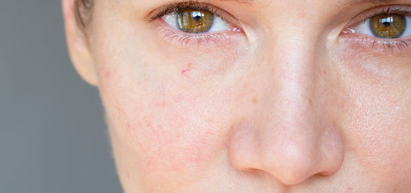 How To Tell If Your Skin Barrier Is Damaged - Signs Of A Damaged Skin ...