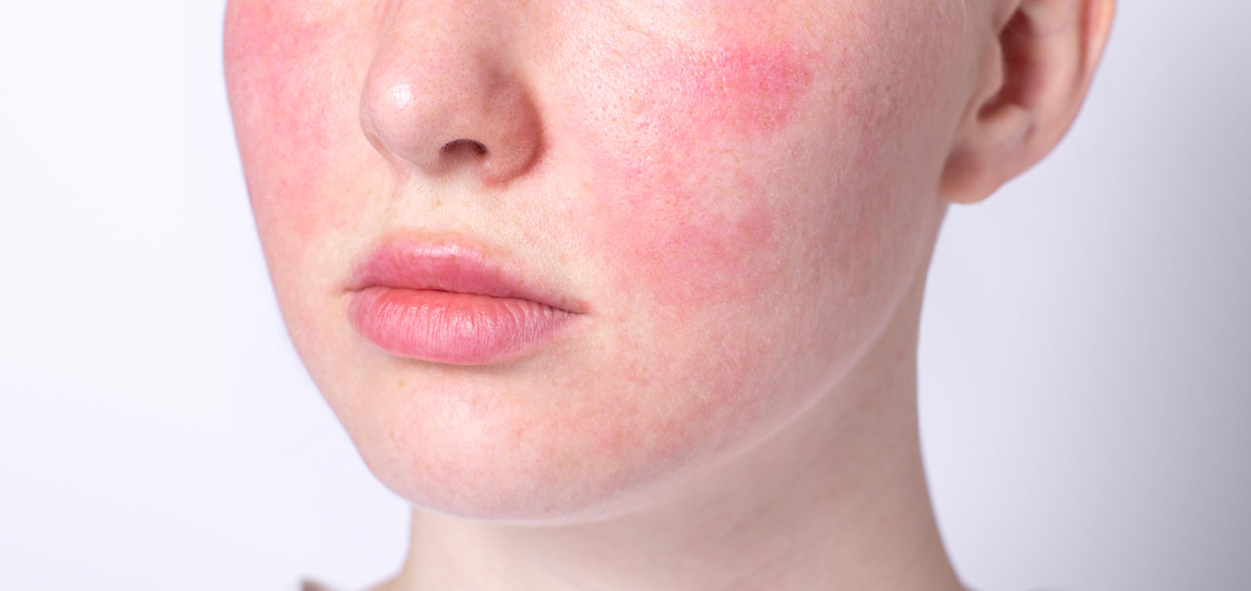 Skincare for Rosacea: 7 Tips for Calm and Healthy Skin